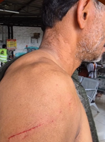 തെരുവുനായ ആക്രമണം:മധ്യവയസ്കന് പരിക്ക്