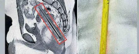 കാൽമുട്ടു വേദനയുമായി ആശുപത്രിയിലെത്തി; ചികിത്സയ്ക്കിടെ ‘ട്വിസ്റ്റ്’: ‘കാണാതായ’ പെൻസിൽ ശസ്ത്രക്രിയയിലൂടെ പുറത്തെടുത്തു