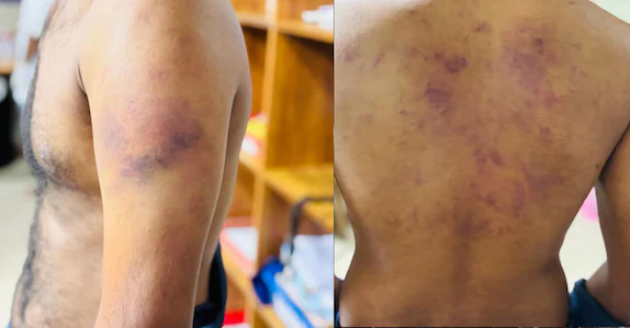 ഹണിട്രാപ്പിൽ കുടുക്കാൻ വിളിച്ചുവരുത്തി; ലൈംഗികബന്ധത്തിന് വിസമ്മതിച്ച യുവാവിനു ക്രൂരമർദനം