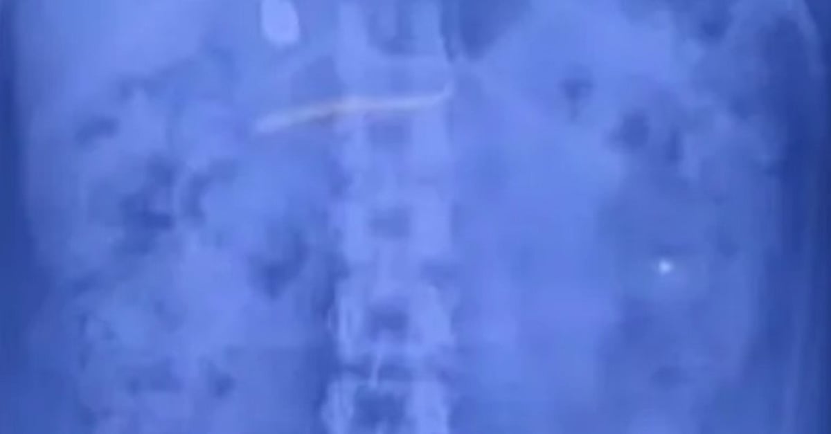 കുഞ്ഞിനെ ലാളിക്കുന്നതിനിടെ സ്വര്‍ണമാല വിഴുങ്ങി; മലപ്പുറത്ത് യുവതി പിടിയില്‍