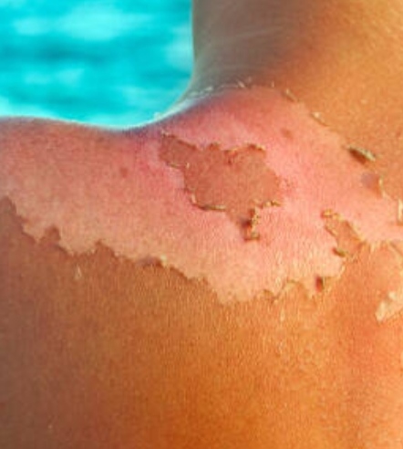 പതിമൂന്നുകാരന് സൂര്യാതപമേറ്റു: സംഭവം ബത്തേരിയിൽ